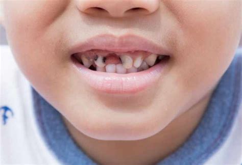 Rotten Teeth Kids Usually Experience: Causes and Treatment - LessConf