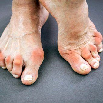 Rheumatoid Arthritis Feet