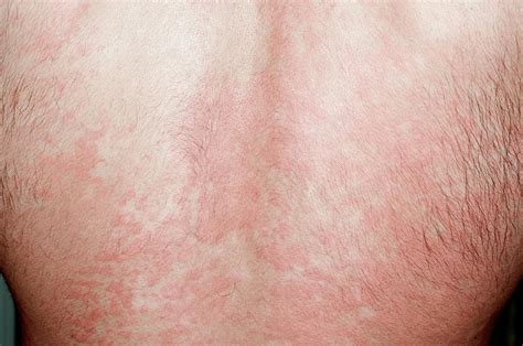 Urticaria Rash On The Back Photograph by Dr P. Marazzi/science Photo ...