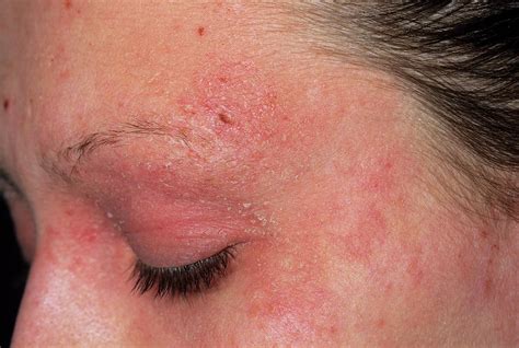 Eczema On A Girl's Face Photograph by Dr P. Marazzi/science Photo Library