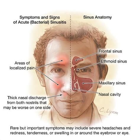 Acute Sinusitis | Sinus infection remedies, Sinusitis, Sinus remedies