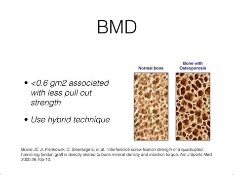 Acl graft fixation options