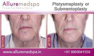 Platysmaplasty Mumbai | Platysmaplasty Surgery, Surgeon, Clinic, Cost Mumbai