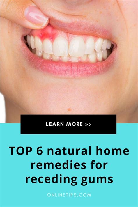 Top 6 natural HOME REMEDIES for RECEDING GUMS | Receding gums, Natural ...