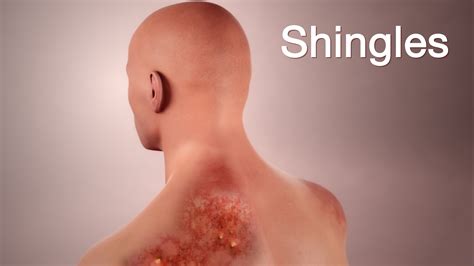 Shingles Disease Clipart