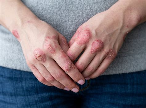 Is Inverse Psoriasis Natural Treatment Right For Me?