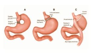 👉 Bariatric Surgery - Types, Cost, Procedure, Complications (November 2021)