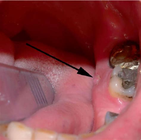 Figure 1 from Osteonecrosis of the Jaw after a Single Bisphosphonate Infusion in a Patient with ...