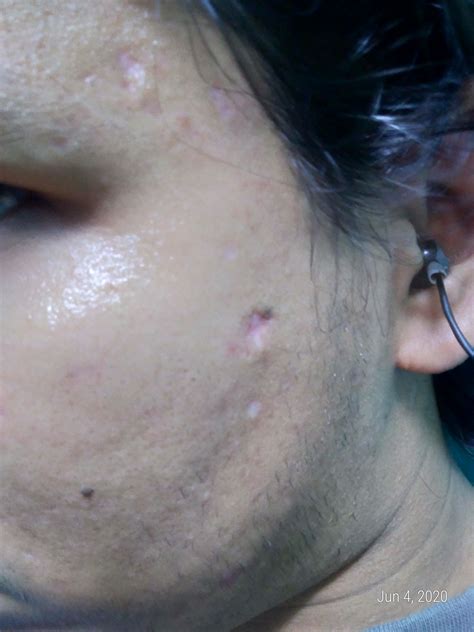 Chicken pox scars after excision.what next? - Scar treatments - Acne.org