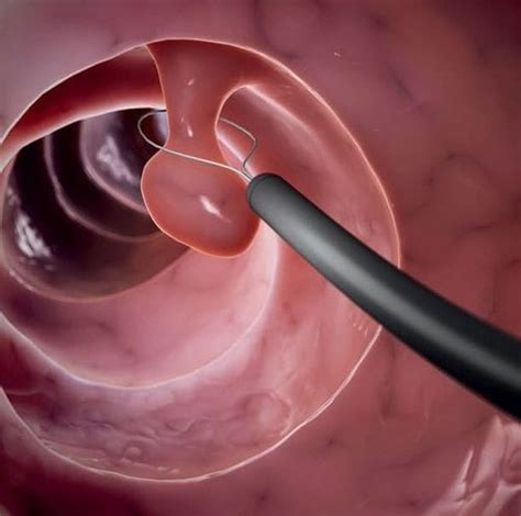 Understanding Colon Polyps and Their Treatment - Crowne Point Endoscopy and Surgery Center ...