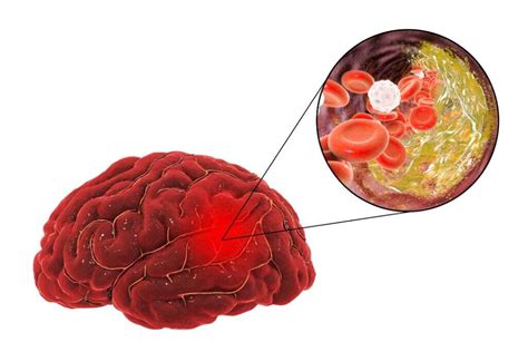 Ischemic Stroke: What Is an Ischemic Stroke?