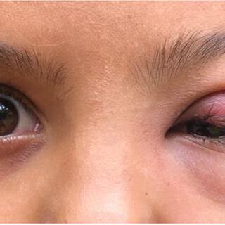 Left palpebral edema and erythema secondary to Cordylobia anthropophaga... | Download Scientific ...