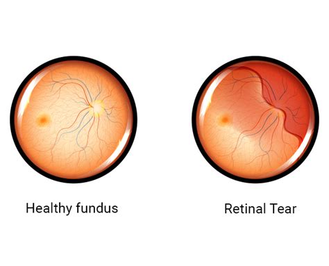 Retinal Tear: Symptoms, Causes & Treatments | Goyal Eye