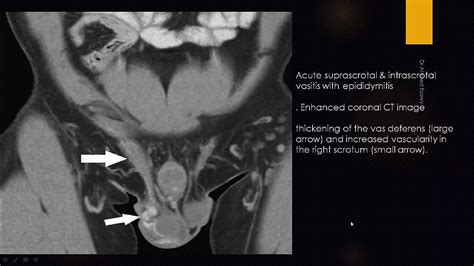 IMAGING FUNICULITIS (SPERMATIC CORD) & VASTITIS (VAS DEFERENS) - YouTube