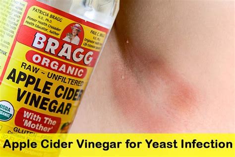 How to Use Apple Cider Vinegar for Vaginal Yeast Infection