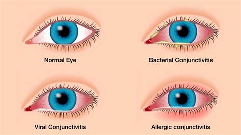 Bacterial Conjunctivitis