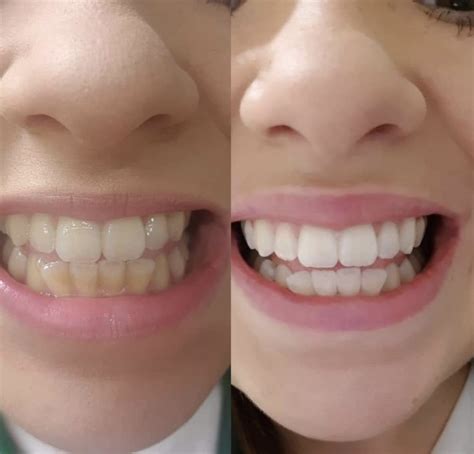 Laser Teeth Whitening Bournemouth & Ringwood