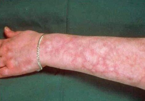 Livedo Reticularis (Mottling Skin) Causes, Pictures, Treatment