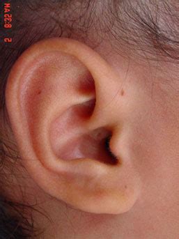 Preauricular Cysts and Ear Cysts – ENT 4 kids