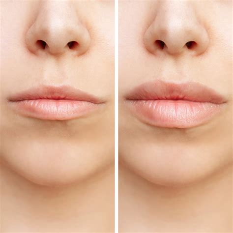 Lip Fillers: What To Expect, Types, Benefits Side Effects, 57% OFF