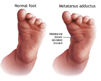 Metatarsus Adductus & Banana Feet Causes | Elite Podiatry