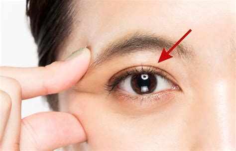 Double Eyelid: Pics, Surgery, and Other Treatments