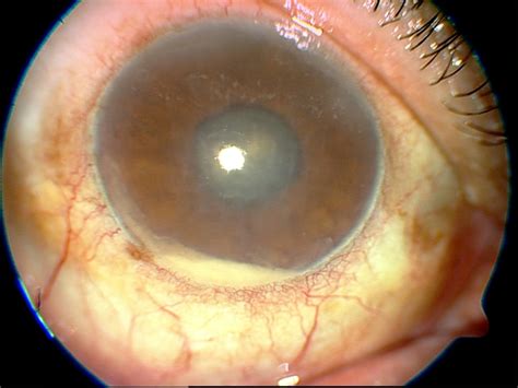 Ten Tips for Managing a Case of Postoperative Endophthalmitis