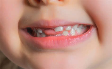 When Do Milk Teeth Fall Out in Children? Learn More Here