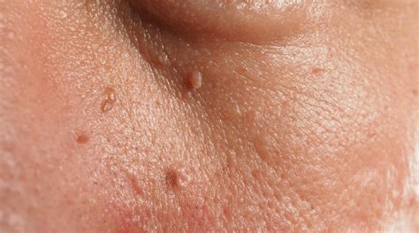 Understanding Skin Tags: Causes and Treatment Options - SBA Dermatology
