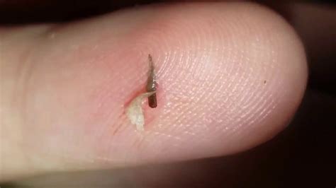 Satisfying Video Splinter Removal Part 1 - YouTube