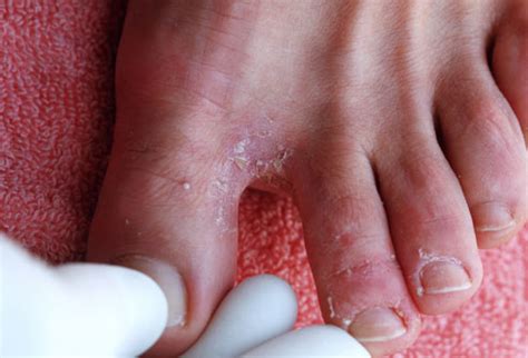 Tinea Pedis