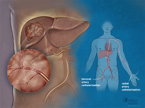 Transarterial Chemoembolisation (TACE) for Liver Cancer | IRSA