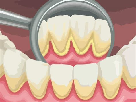 Dental plaque and tartar - How Deep Teeth Cleaning treats gum disease