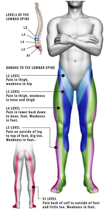 Sciatica (Lumbar Radiculopathy) - Shore Spine & Pain