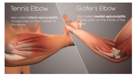 Elbow Injuries | Advanced Training and Rehab