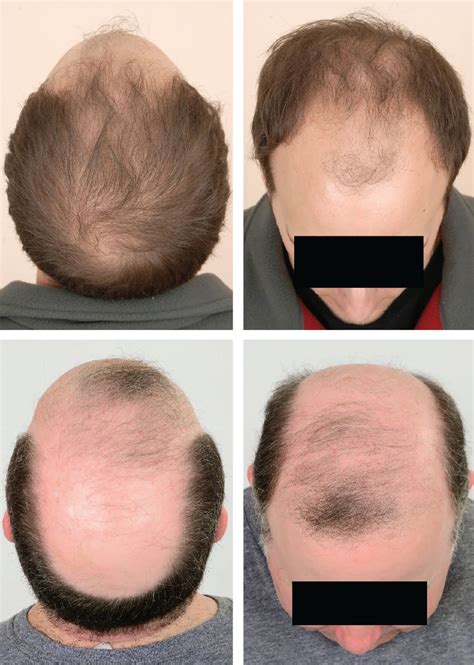 Dialysis On Male Thin Hair