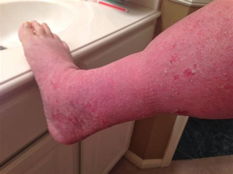 Dave's Topical Steroid Withdrawal: January 31 - MRSA