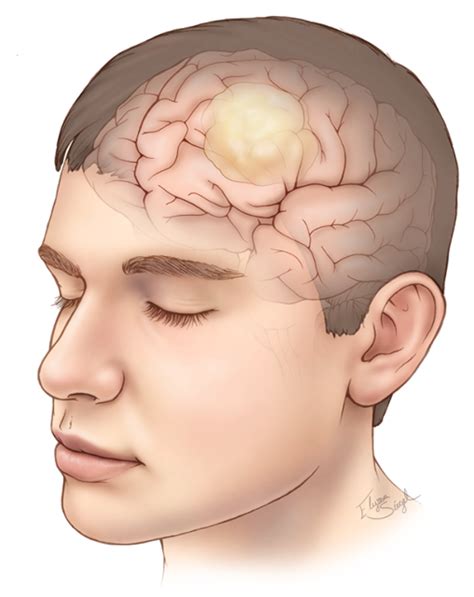 Glioma - Symptoms & Causes | Expert Surgeon | Aaron Cohen-Gadol, MD