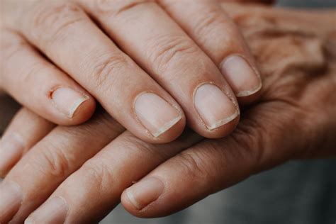 Nails With Toenail Fungus: The Wonders of Baking Soda For Nail Fungus ...