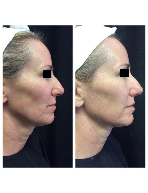 Ultherapy Before And After