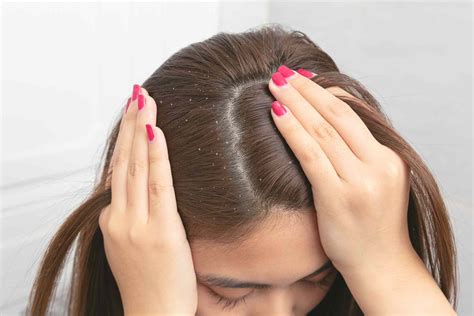 ¿Qué está causando escamas en tu cabello y cómo tratarlas? - Medicina Básica