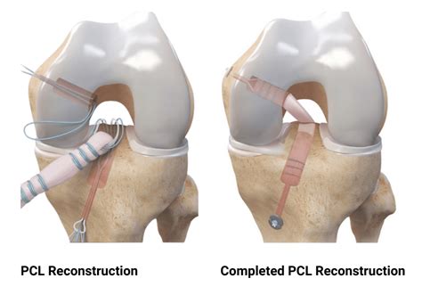 Torn knee ligaments surgery | doctorvisit