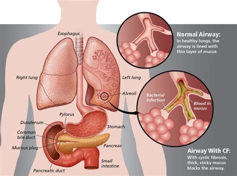 3-Ingredient Remedy That Clears Lung Mucus Immediately | Clear lungs, Mucus, Cystic fibrosis