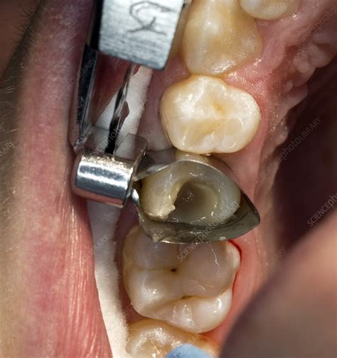 Dental filling cavity preparation - Stock Image - C029/1845 - Science Photo Library