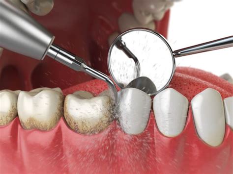 Dental Plaque Removal