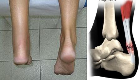 Achilles Tendon Rupture - Causes, Symptoms, Treatments, and Diagnosis ...