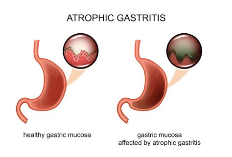 Atrophic Gastritis: Everything You Need to Know