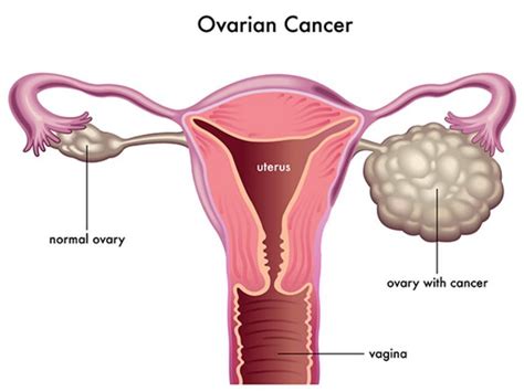 Do I have Polycystic Ovaries?