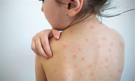 Measles Rash