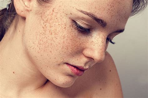 Hyperpigmentation – Symptoms, Causes, And Treatments | Body Projex